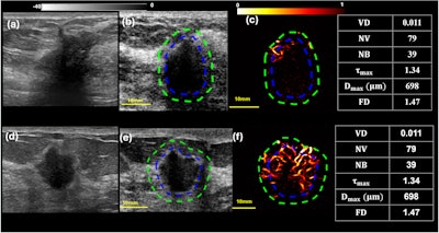 Examples of an 18 mm radial scar (top row) and a 15 mm invasive ductal carcinoma (bottom row) breast lesions. (a,d) show clinical B-mode images, (b,e) depict B-mode images in plane wave imaging mode, and (c,f) illustrate qHDMI generated microvasculature images. Tables to the right of the images indicate qHDMI biomarker values. The blue and green dashed curves indicate the segmented lesion boundaries, before and after 2mm dilation, respectively. Images are republished under a Creative Commons license (CC BY-NC-ND 4.0).