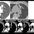 2025 10 14 Tumor Seeding Thumbnail