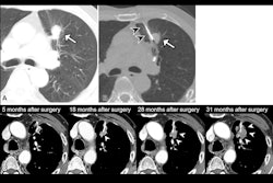 2025 10 14 Tumor Seeding Thumbnail