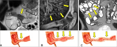 The Stenosis Therapy and Anti-Fibrotic Research (STAR) Consortium definition of a single stricture. (A) Coronal MR image and illustration show a single bowel segment with continuous luminal narrowing and bowel wall thickening (arrows). (B) Coronal MR image and illustration show multiple narrowed segments linked by imaging findings of inflammation, such as mesenteric border inflammation (arrows). (C) Coronal MR image and illustration show multiple narrowed segments (arrows) separated by 3 cm or less. Images and caption courtesy of the RSNA.