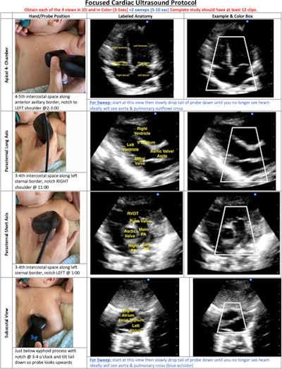 An overview of the focused cardiac ultrasound protocol described in the study. Images are republished under a Creative Commons license (CC BY 4.0).
