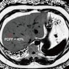 2025 10 21 Liver Mri Derived Proton Density Fat Fraction Thumbnail