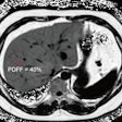 2025 10 21 Liver Mri Derived Proton Density Fat Fraction Thumbnail