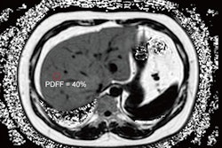 2025 10 21 Liver Mri Derived Proton Density Fat Fraction Thumbnail