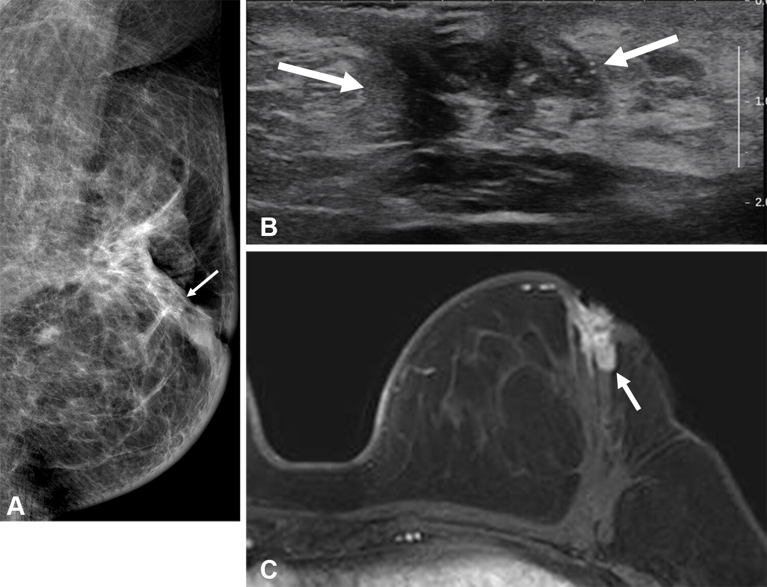 Images in a 49-year-old patient originally treated for hormone receptor-positive invasive cancer without preoperative MRI who developed bloody nipple discharge two years after surgery. (A) Left mediolateral oblique mammogram shows new grouped pleomorphic calcification (arrow) adjacent to the previous operation site. (B) Transverse ultrasound image shows a 2.3-cm hypoechoic mass (arrows) with calcifications. (C) Axial contrast-enhanced fat-saturated T1-weighted MRI scan shows an irregular, heterogeneously enhancing mass (arrow) in the left breast, adjacent to the operation site. The final pathologic examination confirmed recurrent invasive ductal carcinoma.
