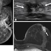 Images in a 49-year-old patient originally treated for hormone receptor-positive invasive cancer without preoperative MRI who developed bloody nipple discharge two years after surgery. (A) Left mediolateral oblique mammogram shows new grouped pleomorphic calcification (arrow) adjacent to the previous operation site. (B) Transverse ultrasound image shows a 2.3-cm hypoechoic mass (arrows) with calcifications. (C) Axial contrast-enhanced fat-saturated T1-weighted MRI scan shows an irregular, heterogeneously enhancing mass (arrow) in the left breast, adjacent to the operation site. The final pathologic examination confirmed recurrent invasive ductal carcinoma.