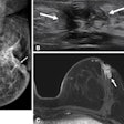 Images in a 49-year-old patient originally treated for hormone receptor-positive invasive cancer without preoperative MRI who developed bloody nipple discharge two years after surgery. (A) Left mediolateral oblique mammogram shows new grouped pleomorphic calcification (arrow) adjacent to the previous operation site. (B) Transverse ultrasound image shows a 2.3-cm hypoechoic mass (arrows) with calcifications. (C) Axial contrast-enhanced fat-saturated T1-weighted MRI scan shows an irregular, heterogeneously enhancing mass (arrow) in the left breast, adjacent to the operation site. The final pathologic examination confirmed recurrent invasive ductal carcinoma.