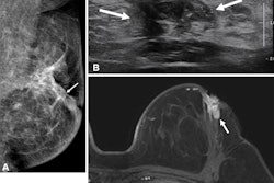Images in a 49-year-old patient originally treated for hormone receptor-positive invasive cancer without preoperative MRI who developed bloody nipple discharge two years after surgery. (A) Left mediolateral oblique mammogram shows new grouped pleomorphic calcification (arrow) adjacent to the previous operation site. (B) Transverse ultrasound image shows a 2.3-cm hypoechoic mass (arrows) with calcifications. (C) Axial contrast-enhanced fat-saturated T1-weighted MRI scan shows an irregular, heterogeneously enhancing mass (arrow) in the left breast, adjacent to the operation site. The final pathologic examination confirmed recurrent invasive ductal carcinoma.
