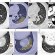 2025 10 21 Radiology Lin Figure6 Thumbnail