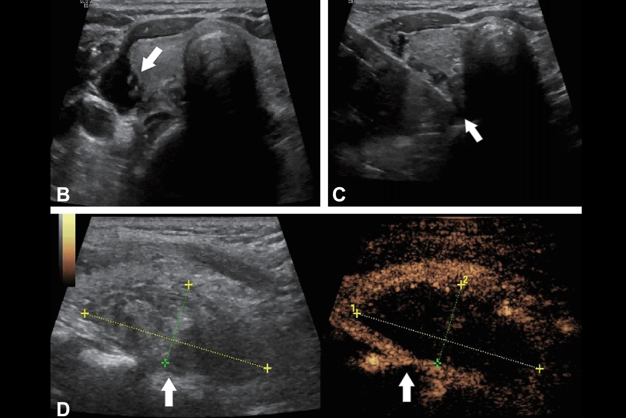 2025 10 28 Safety Of Mwa Rfa Hyperparathyroidism Thumbnail