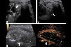 2025 10 28 Safety Of Mwa Rfa Hyperparathyroidism Thumbnail