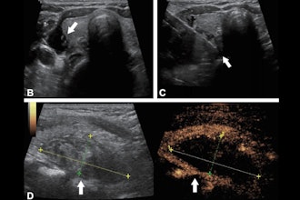 2025 10 28 Safety Of Mwa Rfa Hyperparathyroidism Thumbnail