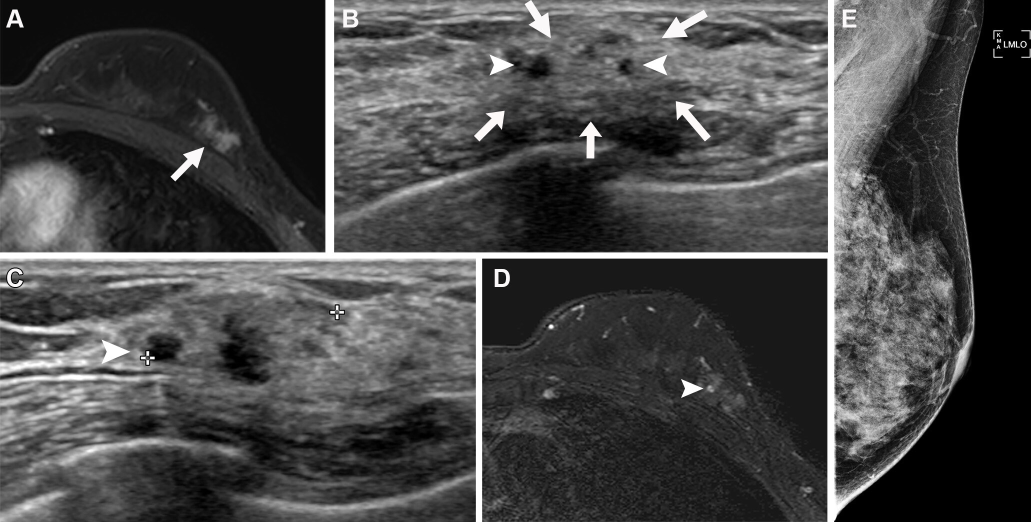 Ultrasound features of nonmass breast lesions differ by indication ...