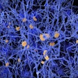 Alzheimers Amyloid