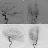 Brain Avms Thumbnail