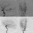 Brain Avms Thumbnail