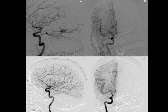 Brain Avms Thumbnail