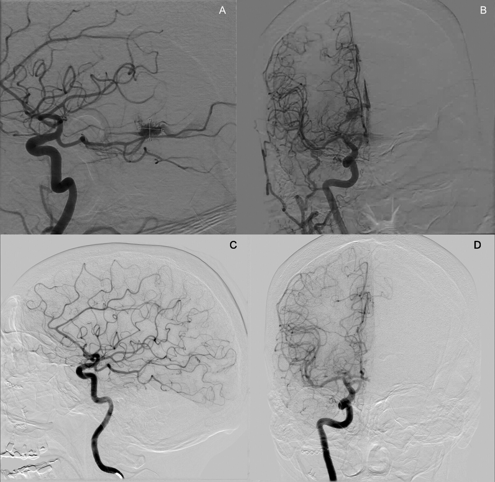 What’s the best treatment for 'eloquent' brain AVMs? | AuntMinnie