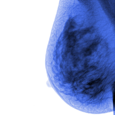 Breast Cancer2 400