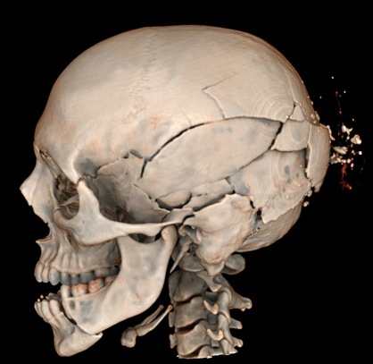 This image depicts comminuted skull fractures sustained in a pedestrian motor vehicle accident. These are difficult to document by a standard autopsy because the individual fragments are displaced during the internal examination and dissection of the head.