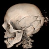 This image depicts comminuted skull fractures sustained in a pedestrian motor vehicle accident. These are difficult to document by a standard autopsy because the individual fragments are displaced during the internal examination and dissection of the head.