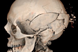 This image depicts comminuted skull fractures sustained in a pedestrian motor vehicle accident. These are difficult to document by a standard autopsy because the individual fragments are displaced during the internal examination and dissection of the head.