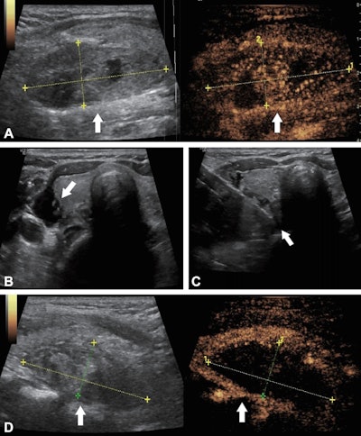 Ultrasound images in a 56-year-old woman with primary hyperparathyroidism treated using ultrasound-guided microwave ablation. (A) Preablation longitudinal images reveal a hypoechoic parathyroid nodule (arrow) measuring 4.84 × 1.86 × 2.53 cm. The B-mode image (left) shows the nodule, while the contrast-enhanced image (right) demonstrates hyperenhancement of the solid component of the parathyroid lesion. The coordinate axes indicate the measured maximum diameters of the nodule. (B) Transverse image shows percutaneous injection of saline solution (arrow) with ultrasound guidance, to create an isolation zone to protect surrounding tissues. (C) Transverse image shows the ablation needle (arrow) positioned within the nodule for microwave ablation. (D) Postablation longitudinal images of the lesion area (arrow). The B-mode image (left) shows the hyperechoic lesion area, while the contrast-enhanced image (right) shows no contrast enhancement, indicating complete ablation. The coordinate axes indicate the maximum diameters of the ablation zone (4.51 × 1.85 × 2.04 cm).