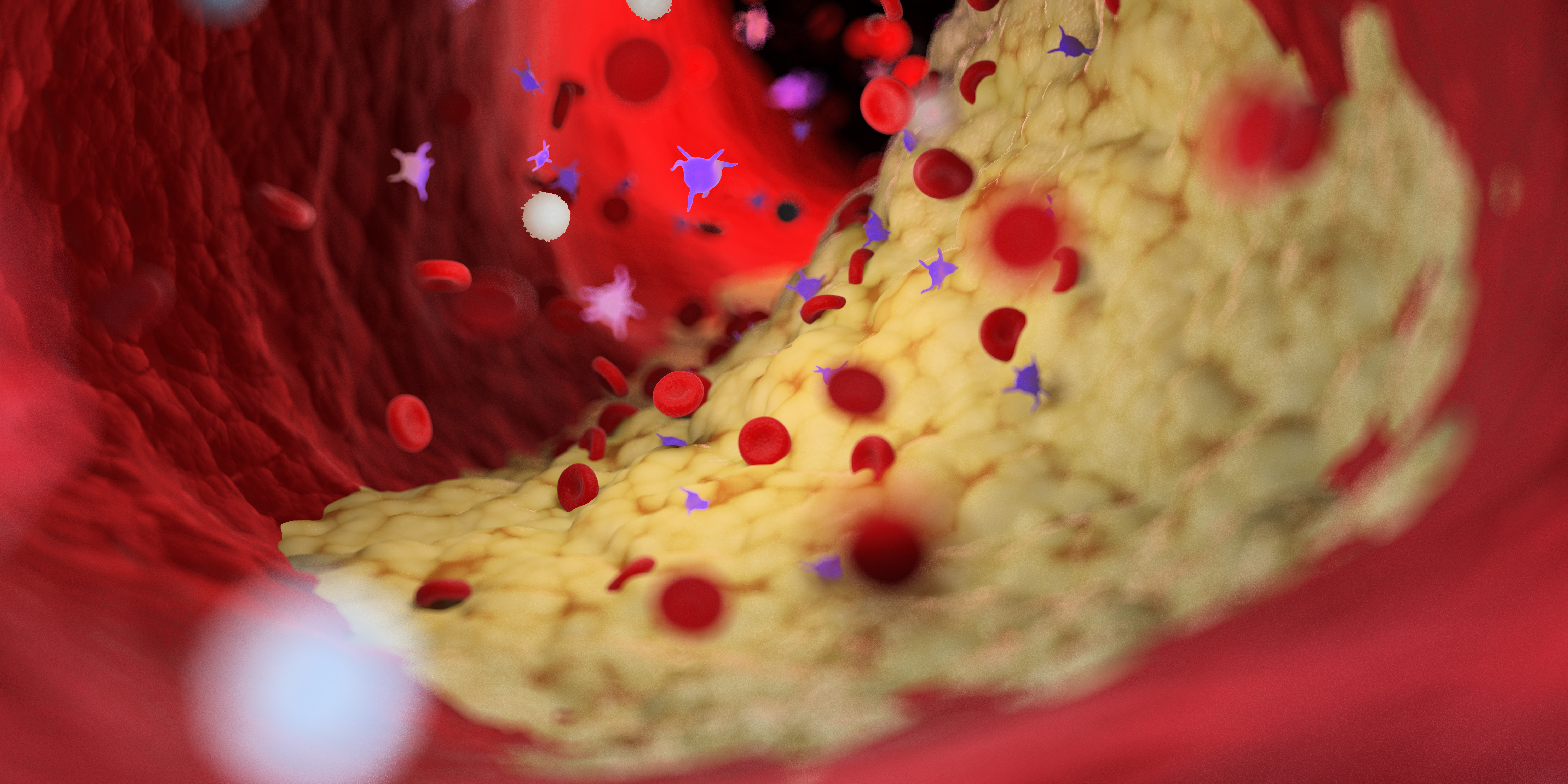 Plaque Artery 6 Wie8o8kz T