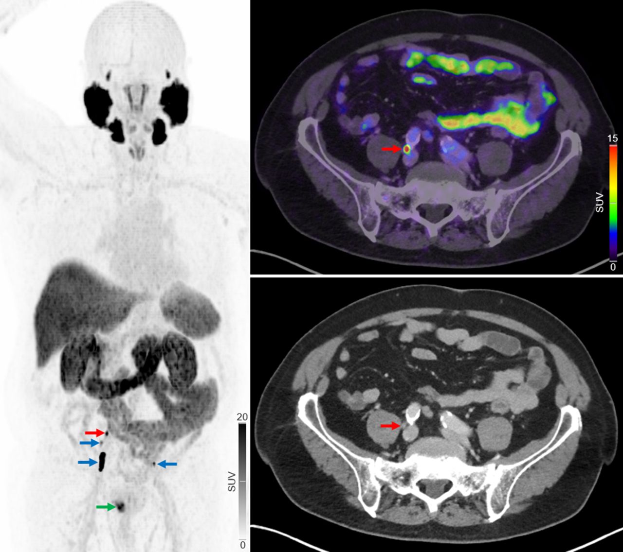 PSMA-PET/CT may replace NaF-PET/CT in advanced prostate cancer | AuntMinnie