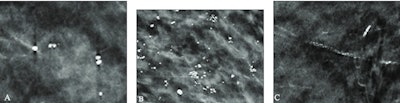 Examples of AI-only flagged findings corresponding with benign calcifications. (A to C) Synthetic views from false-positive screening DBT examinations in three different patients, including dystrophic round calcifications in 63-year-old patient (A), skin calcifications in 49-year-old patient (B), and vascular calcifications in 71-year-old patient (C). No patient was diagnosed with breast cancer within one year after screening examination.