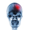 Stroke Skull Xray 400