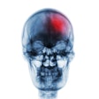 Stroke Skull Xray 400