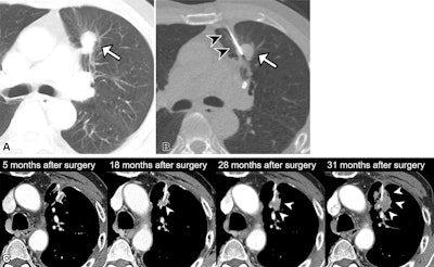 Remnant lung recurrence after percutaneous transthoracic needle biopsy (PTNB) following wedge resection. (A) Preoperative contrast-enhanced axial CT scan in a 76-year-old male patient shows a 1.8-cm solid nodule in the left upper lobe (arrow). (B) The patient underwent PTNB for nodule diagnosis. A nonenhanced axial CT scan showed that the introducer needle (arrowheads) was inserted into the inner portion of the nodule (arrow), traversing the lung parenchyma. The diagnosis on the basis of results from the PTNB was adenocarcinoma, and the patient subsequently underwent left upper lobe wedge resection 7 days after PTNB was performed. The final diagnosis was adenocarcinoma of the solid-predominant type, pT1bN0. (C) At postoperative follow-up, a nodular opacity emerged adjacent to the surgical site (arrowheads) and increased in size at subsequent imaging. This soft-tissue lesion was confirmed at PTNB as metastatic adenocarcinoma, and the patient underwent salvage radiation to treat the remnant lung recurrence.