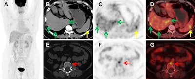 Images of a 56-year-old female with recurrence of choriodal melanoma two years after left eye enucleation. (A) Maximum intensity projection (MIP) images showed multiple metastatic lesions. B-D Axial CT (B), PET (C), and fused PET/CT (D) images showed liver metastasis (green arrows) and splenic metastasis (yellow arrows). E-G images showed an L2 vertebral metastasis without density changes (red arrows).