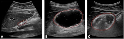 Representative images obtained during this study illustrating an empty (A) gastric antrum (outlined in red), one filled with liquid (B), and one filled with solid food components (C). Images available for republishing under Creative Commons license (CC BY 4.0).