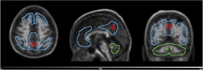 Volume with higher baseline signal for N1 accumulators and N1 non-accumulators of amyloid (red line) overlayed on the scan of an N1 accumulator (MNI space). Grey scale shows SUVR range. Blue line shows the Centiloid target region and the green line shows the reference region (whole cerebellum).