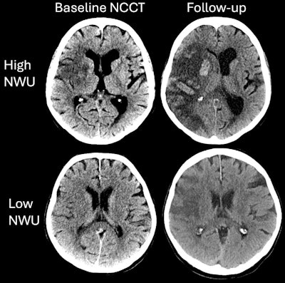 Axial noncontrast CT (NCCT) images in patients in The Efficacy and Safety of Thrombectomy in Stroke with Extended Lesion and Extended Time Window (TENSION) trial who underwent endovascular thrombectomy with low versus high ischemic lesion attenuation. The two cases highlighting differences in relative hypoattenuation in patients included in the TENSION trial. Patient 1 (upper row) was a 74-year-old female with acute ischemic stroke due to a proximal occlusion of the right middle cerebral artery, NCCT, axial plane; no contrast used. Baseline Alberta Stroke Program Early CT Score (ASPECTS) was 5, with high net water uptake (NWU). Patient 2 (lower row) was a 68-year-old male with acute ischemic stroke due to a proximal occlusion of the right middle cerebral artery; NCCT, axial plane; no contrast used. Baseline ASPECTS was 3, with low NWU. The patient with high NWU (upper row) died despite successful endovascular treatment. The patient with low NWU (lower row) achieved functional independence (modified Rankin scale score of 2). Images and caption courtesy of the RSNA.