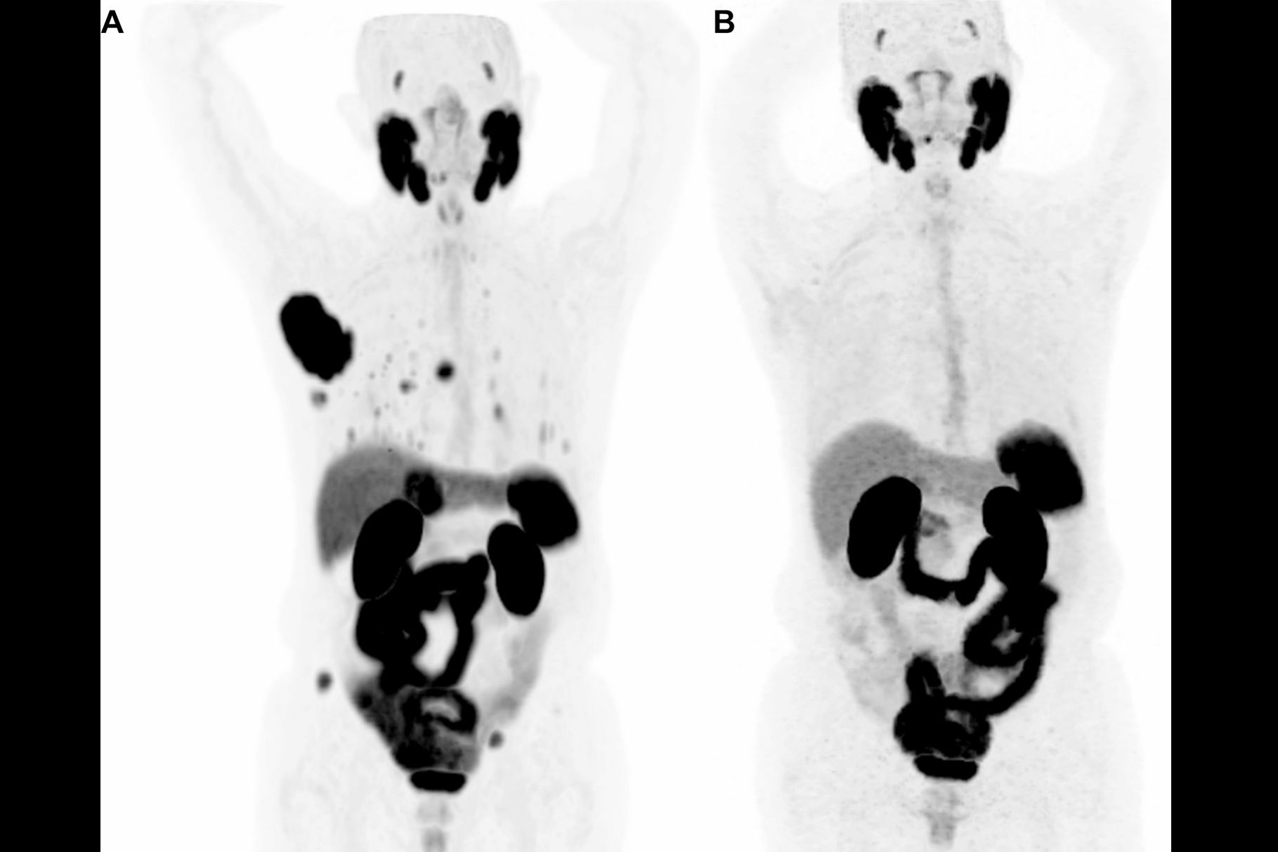 2025 11 06 Psma Pet Hcc Thumbnail