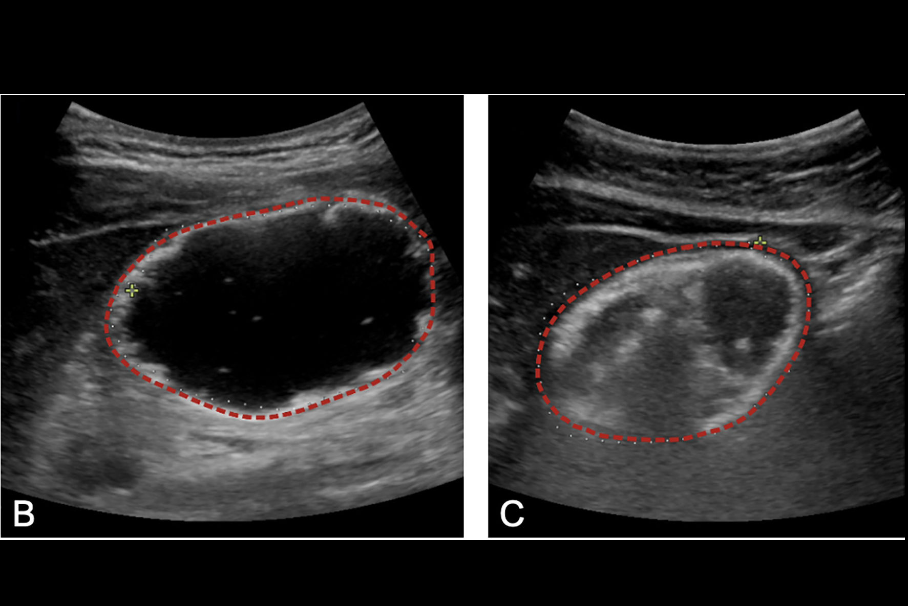 2025 11 10 Gastric Ultrasound Thumbnail