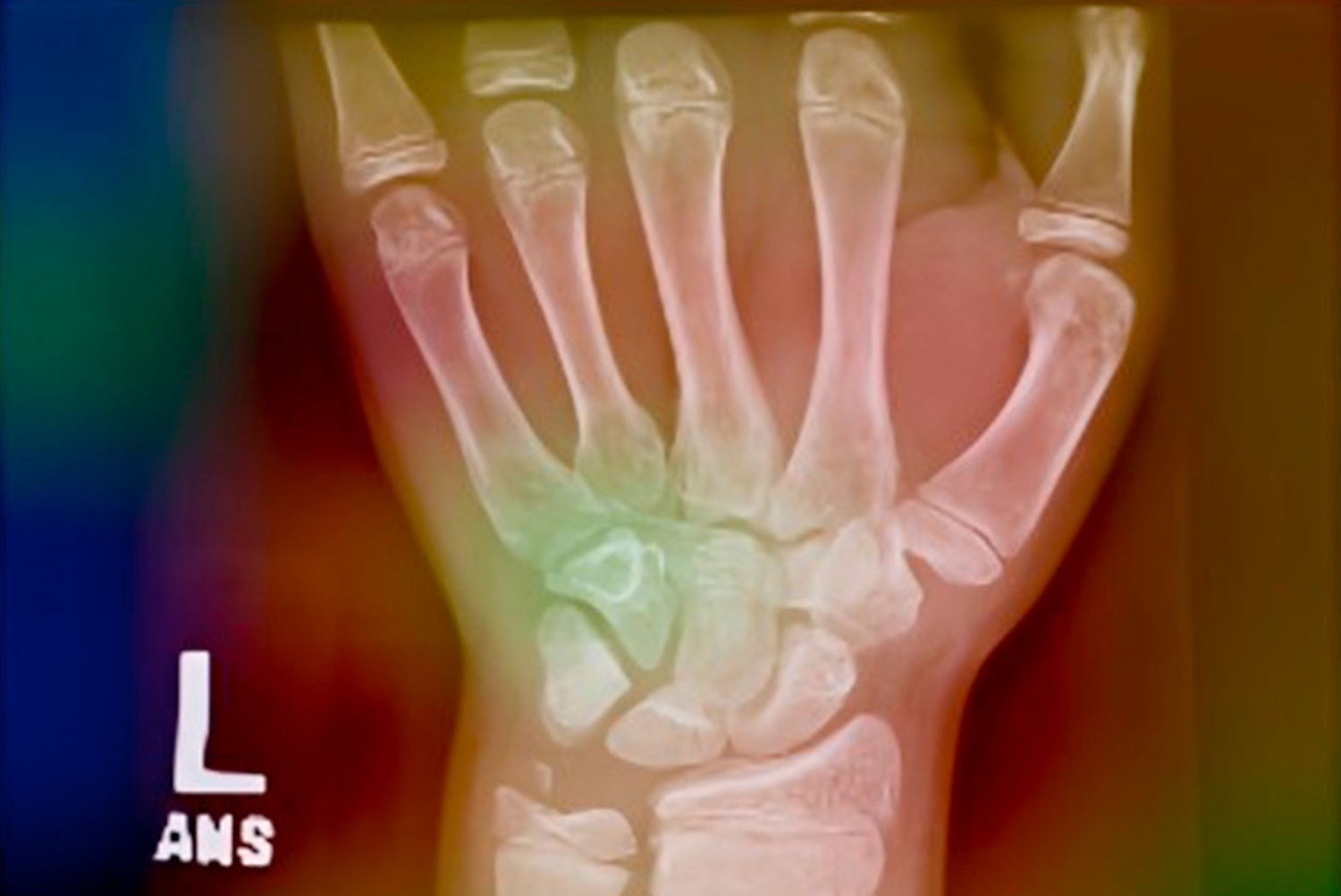 2025 11 10 Physeal Fracture Thumbnail