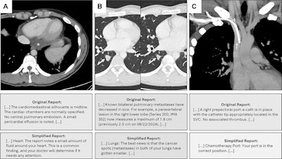 Chest CT images in a participant with metastatic nonseminoma, with relevant text from the original and simplified reports below each image (see Table S8 for the full reports). (A) Axial image shows pericardial effusion (*). (B) Axial images from a previous examination (left) and the current examination (right) show regressing pulmonary metastasis (arrow). (C) Coronal image shows right prepectoral port catheter with the tip in the superior vena cava (SVC) (†). This example does not contain errors in the text presented.