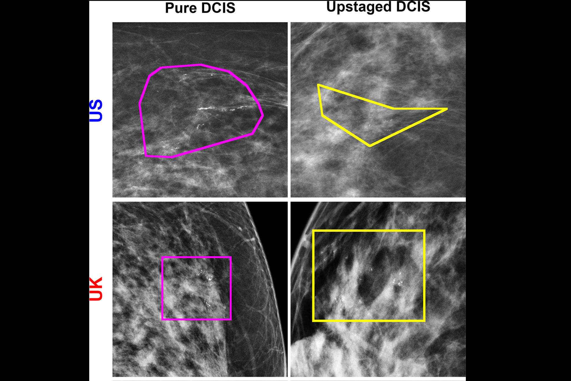 2025 11 18 Mammography Dcis Thumbnail