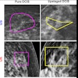 2025 11 18 Mammography Dcis Thumbnail
