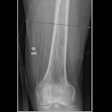 2025 11 20 Thigh Muscle X Ray Thumbnail