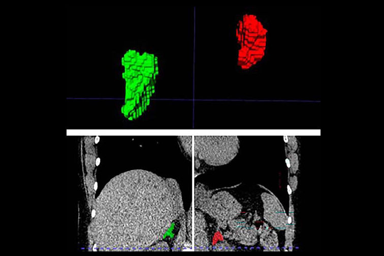 2025 11 21 2d 3d Segmentation Chestct Thumbnail