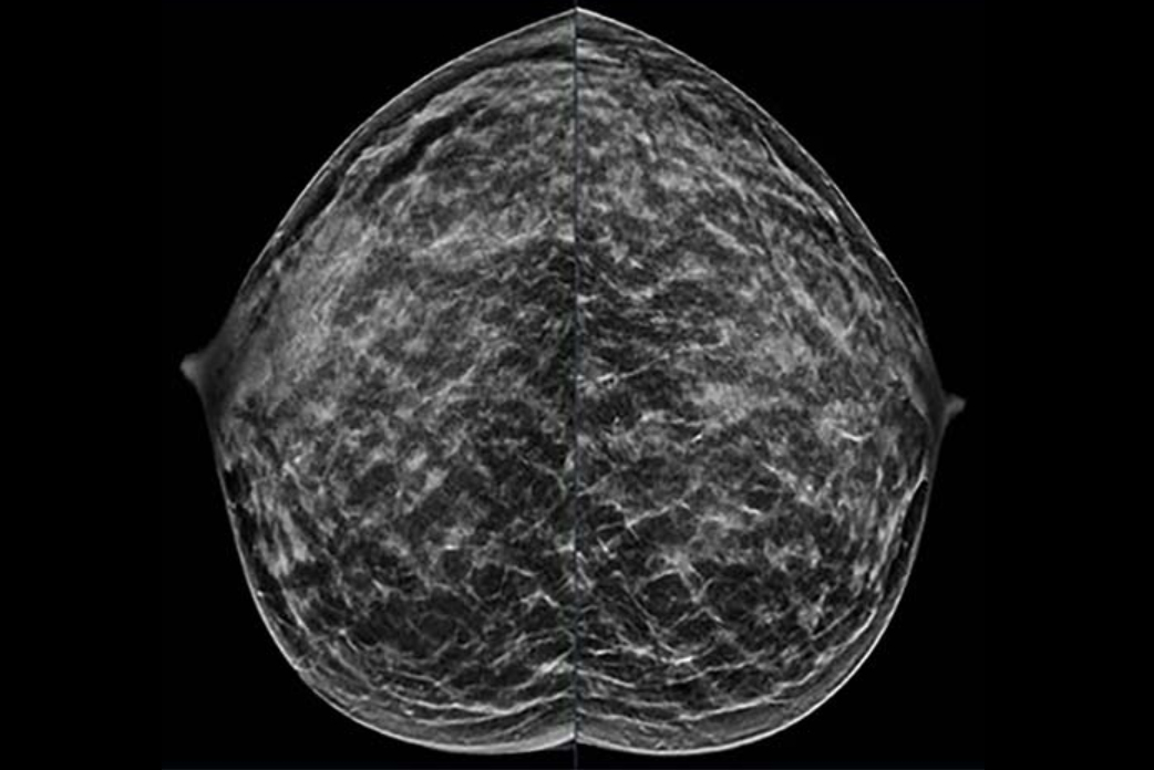 2025 11 24 Destounis Breast Cancer Thumbnail