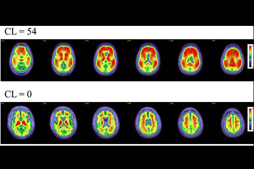 2025 11 25 Amyloid Positive Scans Figure 5 Thumbnail