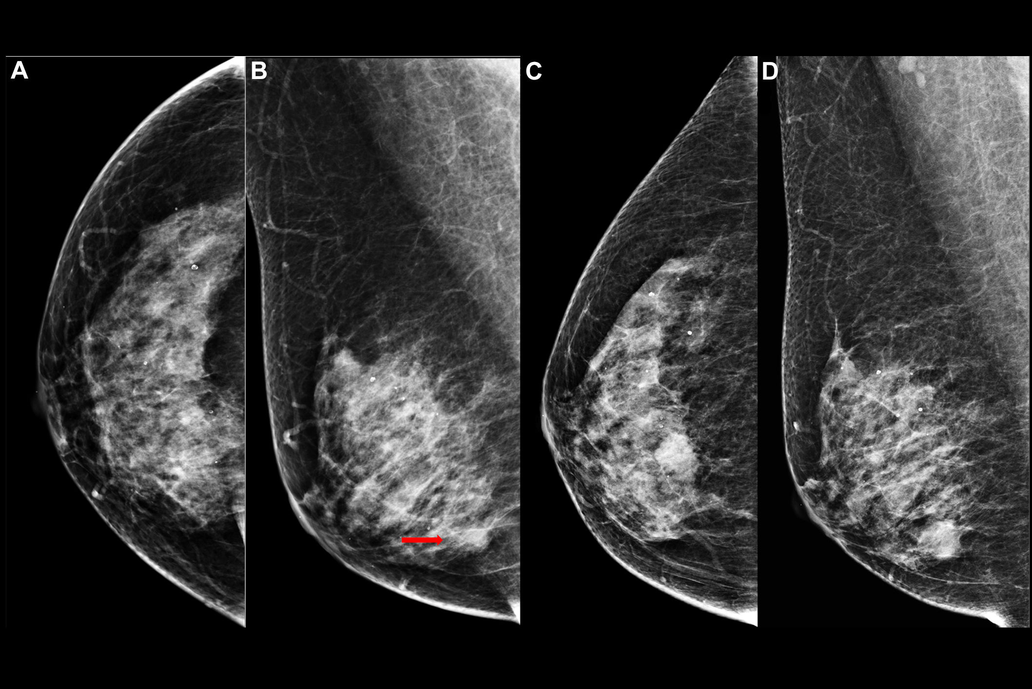 2025 11 25 Radiology Mammograms Interval Cancers Thumbnail