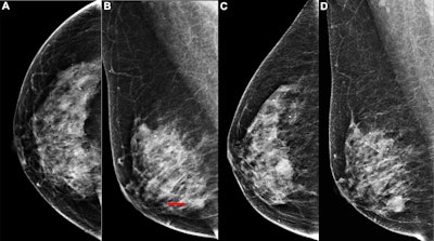 Images depict the right breast in a 63-year-old woman with interval breast cancer. (A, B) Screening mammograms in the (A) craniocaudal and (B) mediolateral oblique views show a right breast asymmetry (arrow) initially interpreted as normal tissue (BI-RADS category 2). (C, D) Diagnostic mammograms 17 months later in the (C) craniocaudal and (D) mediolateral oblique views reveal a high-density oval mass with indistinct margins. Ultrasound examination (not shown) demonstrated a 15.9 × 11.2 × 9.6 mm irregular hypoechoic mass, which was confirmed at biopsy to be invasive ductal carcinoma grade I.