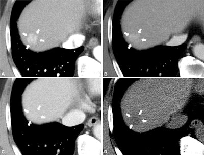 Axial CT images in a 67-year-old man with hepatitis B virus infection–related liver cirrhosis show a 1.8-cm hepatic observation in segment VIII (arrows). The lesion shows (A) nonrim arterial phase hyperenhancement without nonperipheral washout and it remains (B) mildly hyperenhancing in the portal venous phase and shows (C) isoattenuation in the delayed phase. No ancillary features are visible, and the lesion is categorized as LR-3 according to Liver Imaging Reporting and Data System, or LI-RADS, version 2018. (D) On the precontrast image, the lesion appeared as a low attenuating lesion and was upgraded to LR-4 based on precontrast low attenuation as an ancillary feature favoring malignancy. Pathologic examination after hepatic resection served to confirm hepatocellular carcinoma. Images and caption courtesy of the RSNA.